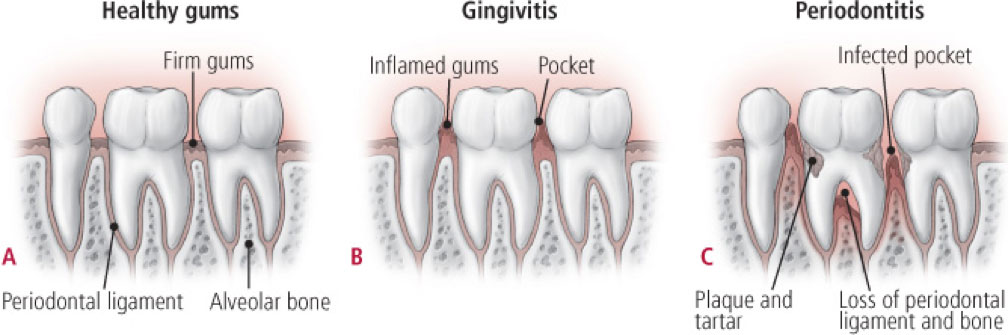 Gum Disease Maintenance and Periodontics