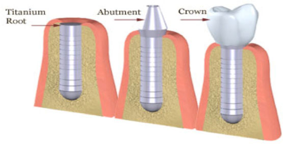 Surgical Implants Process